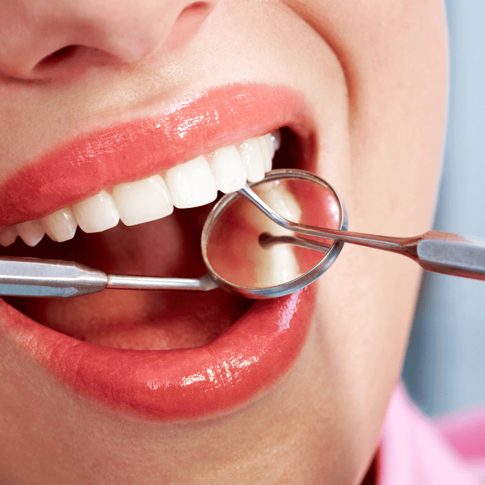 Fillings Image